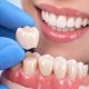 Dental Crowns: A Complete Guide to Restoring Damaged Teeth